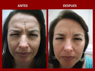 ANTES                                          DESPUES