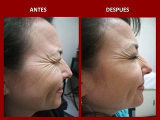 ANTES                                          DESPUES