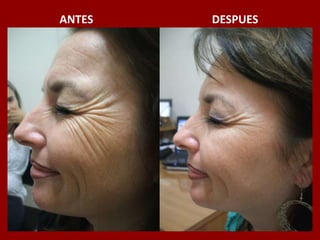 ANTES                                          DESPUES