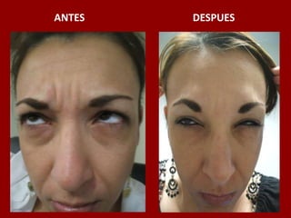 ANTES                                          DESPUES