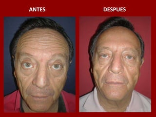 ANTES                                          DESPUES