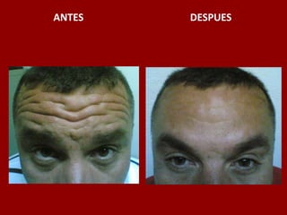 ANTES                                          DESPUES
