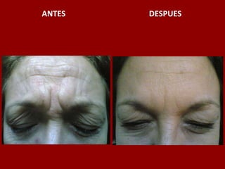 ANTES                                          DESPUES