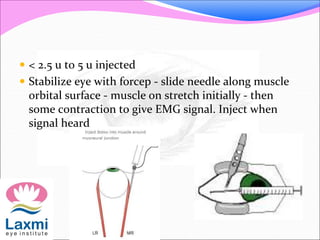  < 2.5 u to 5 u injected
 Stabilize eye with forcep - slide needle along muscle
orbital surface - muscle on stretch initially - then
some contraction to give EMG signal. Inject when
signal heard
 