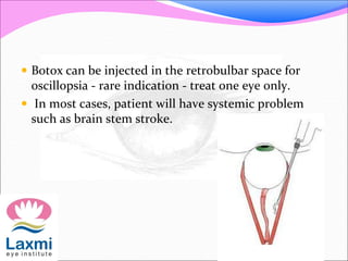  Botox can be injected in the retrobulbar space for
oscillopsia - rare indication - treat one eye only.
 In most cases, patient will have systemic problem
such as brain stem stroke.
 