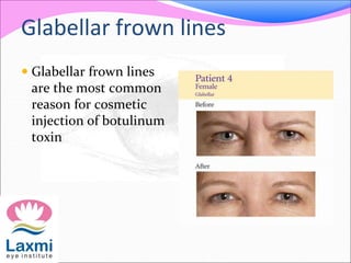 Glabellar frown lines
 Glabellar frown lines
are the most common
reason for cosmetic
injection of botulinum
toxin
 