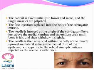  The patient is asked initially to frown and scowl, and the
target muscles are palpated.
 The first injection is placed into the belly of the corrugator
muscle.
 The needle is inserted at the origin of the corrugator fibers
just above the medial canthus and superciliary arch until
bone is felt, and then withdraw it slightly.
 The needle is then advanced within the belly of the muscle
upward and lateral as far as the medial third of the
eyebrow, 1 cm superior to the orbital rim. 4-6 units are
injected as the needle is withdrawn.
 