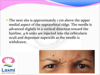  The next site is approximately 1 cm above the upper
medial aspect of the supraorbital ridge. The needle is
advanced slightly in a vertical direction toward the
hairline. 4-6 units are injected into the orbicularis
oculi and depressor supercilii as the needle is
withdrawn.
 
