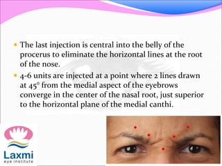  The last injection is central into the belly of the
procerus to eliminate the horizontal lines at the root
of the nose.
 4-6 units are injected at a point where 2 lines drawn
at 45° from the medial aspect of the eyebrows
converge in the center of the nasal root, just superior
to the horizontal plane of the medial canthi.
 