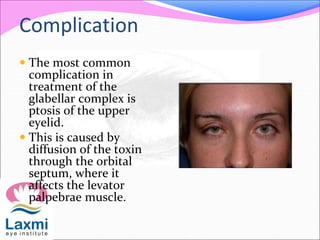 Complication
 The most common
complication in
treatment of the
glabellar complex is
ptosis of the upper
eyelid.
 This is caused by
diffusion of the toxin
through the orbital
septum, where it
affects the levator
palpebrae muscle.
 