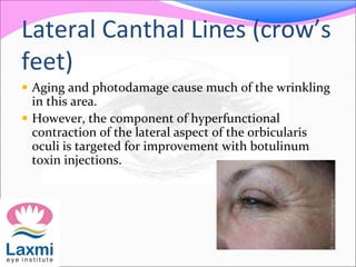 Lateral Canthal Lines (crow’s
feet)
 Aging and photodamage cause much of the wrinkling
in this area.
 However, the component of hyperfunctional
contraction of the lateral aspect of the orbicularis
oculi is targeted for improvement with botulinum
toxin injections.
 