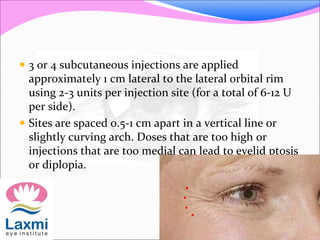  3 or 4 subcutaneous injections are applied
approximately 1 cm lateral to the lateral orbital rim
using 2-3 units per injection site (for a total of 6-12 U
per side).
 Sites are spaced 0.5-1 cm apart in a vertical line or
slightly curving arch. Doses that are too high or
injections that are too medial can lead to eyelid ptosis
or diplopia.
 
