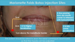 ADVANCED BOTOX COURSE.PART II. HOW TO INJECT BOTOX SAFELY?