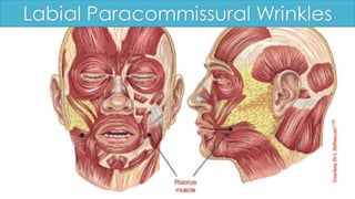 ADVANCED BOTOX COURSE.PART II. HOW TO INJECT BOTOX SAFELY?