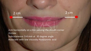 ADVANCED BOTOX COURSE.PART II. HOW TO INJECT BOTOX SAFELY?