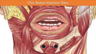 ADVANCED BOTOX COURSE.PART II. HOW TO INJECT BOTOX SAFELY?