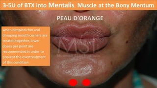 ADVANCED BOTOX COURSE.PART II. HOW TO INJECT BOTOX SAFELY?