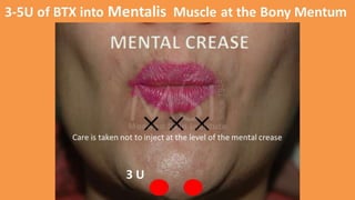 ADVANCED BOTOX COURSE.PART II. HOW TO INJECT BOTOX SAFELY?