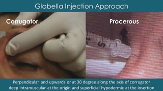 ADVANCED BOTOX COURSE.PART II. HOW TO INJECT BOTOX SAFELY?