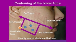 ADVANCED BOTOX COURSE.PART II. HOW TO INJECT BOTOX SAFELY?