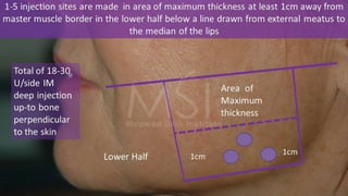 ADVANCED BOTOX COURSE.PART II. HOW TO INJECT BOTOX SAFELY?
