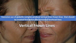 ADVANCED BOTOX COURSE.PART II. HOW TO INJECT BOTOX SAFELY?