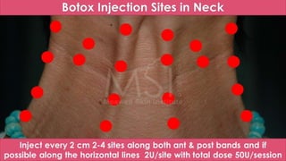 ADVANCED BOTOX COURSE.PART II. HOW TO INJECT BOTOX SAFELY?