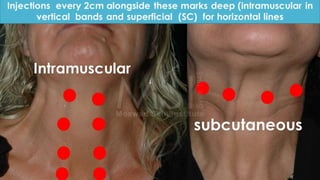 ADVANCED BOTOX COURSE.PART II. HOW TO INJECT BOTOX SAFELY?