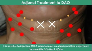 ADVANCED BOTOX COURSE.PART II. HOW TO INJECT BOTOX SAFELY?