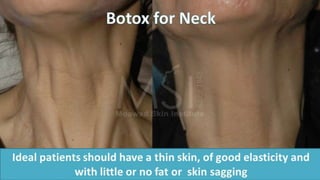 ADVANCED BOTOX COURSE.PART II. HOW TO INJECT BOTOX SAFELY?