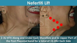 ADVANCED BOTOX COURSE.PART II. HOW TO INJECT BOTOX SAFELY?