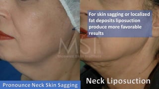 ADVANCED BOTOX COURSE.PART II. HOW TO INJECT BOTOX SAFELY?