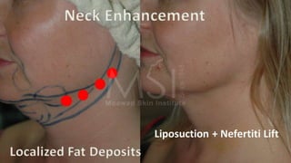 ADVANCED BOTOX COURSE.PART II. HOW TO INJECT BOTOX SAFELY?