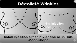 ADVANCED BOTOX COURSE.PART II. HOW TO INJECT BOTOX SAFELY?