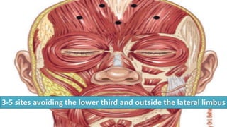 ADVANCED BOTOX COURSE.PART II. HOW TO INJECT BOTOX SAFELY?