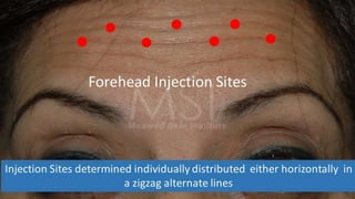 ADVANCED BOTOX COURSE.PART II. HOW TO INJECT BOTOX SAFELY?