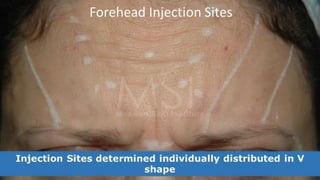 ADVANCED BOTOX COURSE.PART II. HOW TO INJECT BOTOX SAFELY?