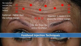 ADVANCED BOTOX COURSE.PART II. HOW TO INJECT BOTOX SAFELY?