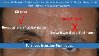 ADVANCED BOTOX COURSE.PART II. HOW TO INJECT BOTOX SAFELY?