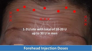 ADVANCED BOTOX COURSE.PART II. HOW TO INJECT BOTOX SAFELY?