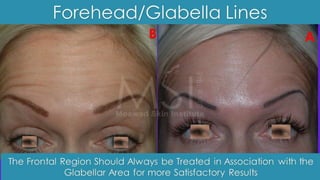 ADVANCED BOTOX COURSE.PART II. HOW TO INJECT BOTOX SAFELY?