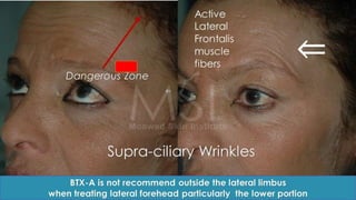 ADVANCED BOTOX COURSE.PART II. HOW TO INJECT BOTOX SAFELY?