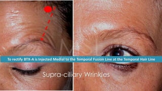 ADVANCED BOTOX COURSE.PART II. HOW TO INJECT BOTOX SAFELY?