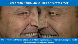 ADVANCED BOTOX COURSE.PART II. HOW TO INJECT BOTOX SAFELY?