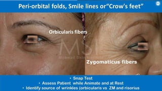 ADVANCED BOTOX COURSE.PART II. HOW TO INJECT BOTOX SAFELY?