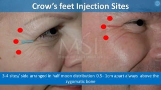 ADVANCED BOTOX COURSE.PART II. HOW TO INJECT BOTOX SAFELY?