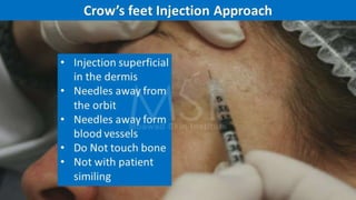 ADVANCED BOTOX COURSE.PART II. HOW TO INJECT BOTOX SAFELY?
