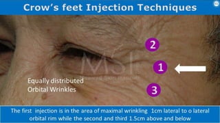 ADVANCED BOTOX COURSE.PART II. HOW TO INJECT BOTOX SAFELY?