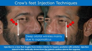 ADVANCED BOTOX COURSE.PART II. HOW TO INJECT BOTOX SAFELY?