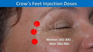 ADVANCED BOTOX COURSE.PART II. HOW TO INJECT BOTOX SAFELY?